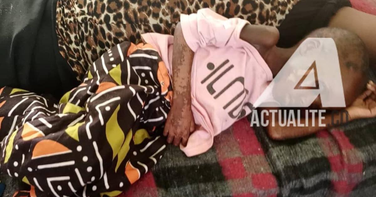 Un cas de malnutrition aigue sévère 