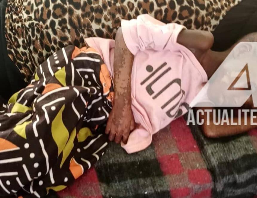Un cas de malnutrition aigue sévère 